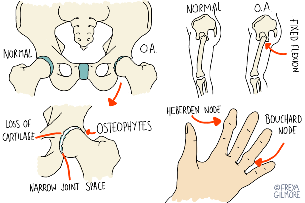 Osteoarthritis in the hip and knee