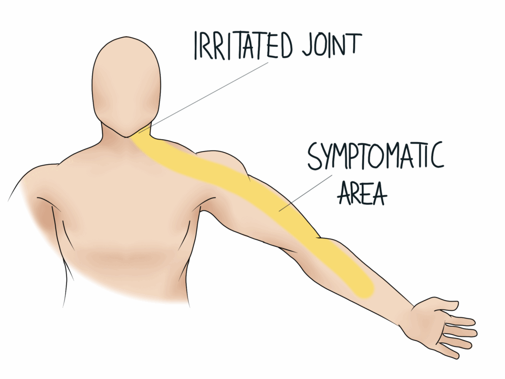 Referred pain in the arm from a neck issue